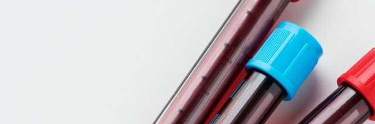 Three small vials of blood two with red caps and one with a blue cap