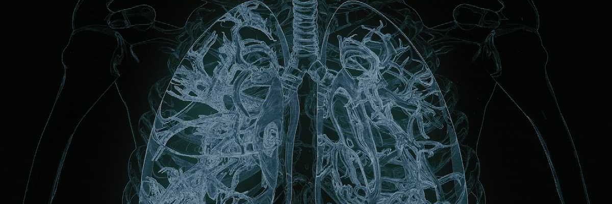 Xray with detailed view of lungs